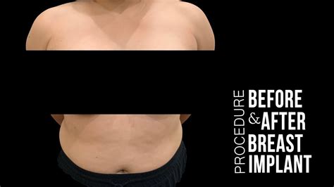 breast implants  cup   cup transformation  della bennett md