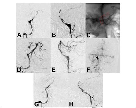 A B Preoperative Angiography Showed An Unruptured Vertebral Artery