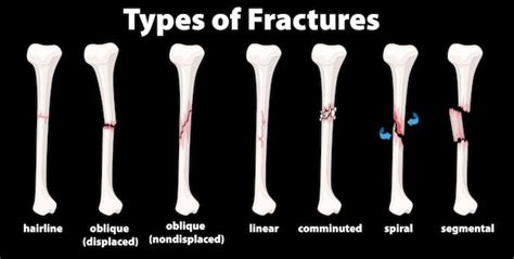 Fracture Diagram