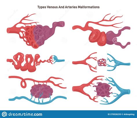 Brain AVM. Tangled Blood Vessels that Connects Arteries and Veins Stock ...