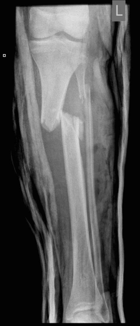 Preoperative Radiograph Of An Unstable Proximal Tibial Fracture