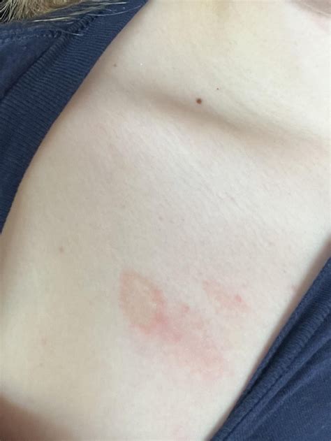 Is this ringworm? : r/medical