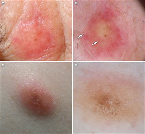 Pure And Mixed Desmoplastic Melanomas Dms May Be Indistinguishable