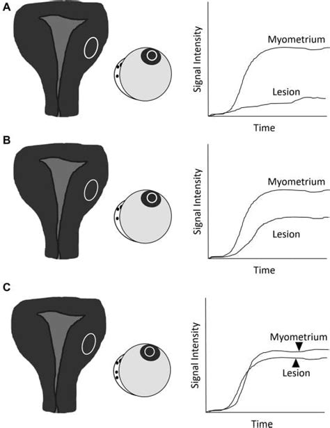 O RADS MRI Calculator RadioGyan