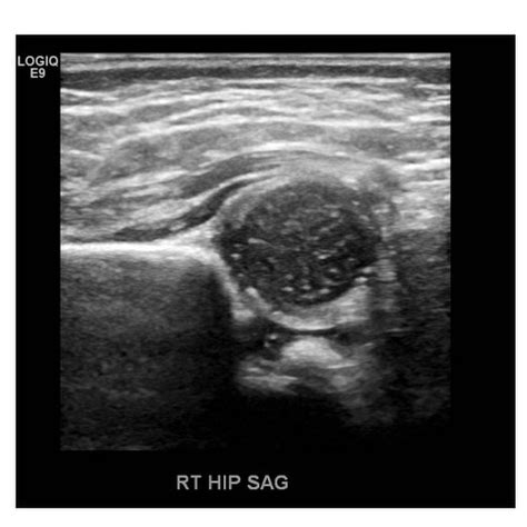 normal pediatric hip ultrasound anatomy refresher. SWIPE 👉🏻 ...