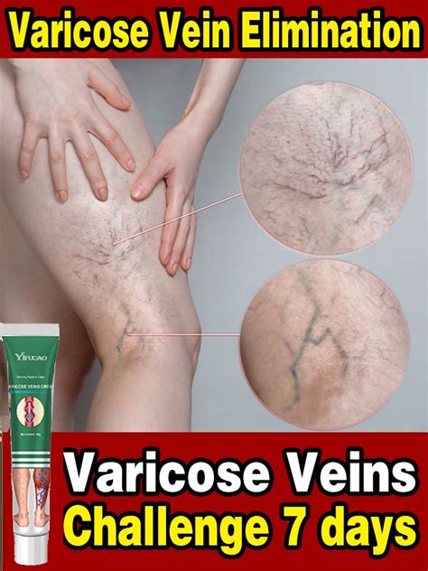 Varicose Veins In Legs Treatment Naturally