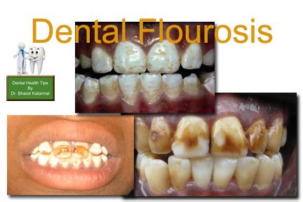 Dental Fluorosis ~ Dr. Bharat Katarmal Dental & Implant Clinic