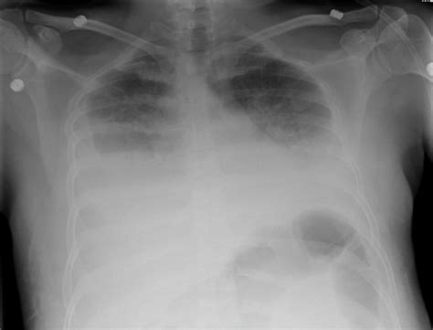 Pleural Effusion Undergraduate Diagnostic Imaging Fundamentals