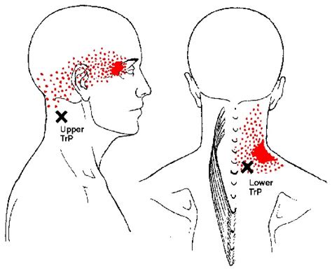 Splenius Capitis and Cervicis Trigger Points and Referred Pain Patterns – triggerpointselfhelp.com