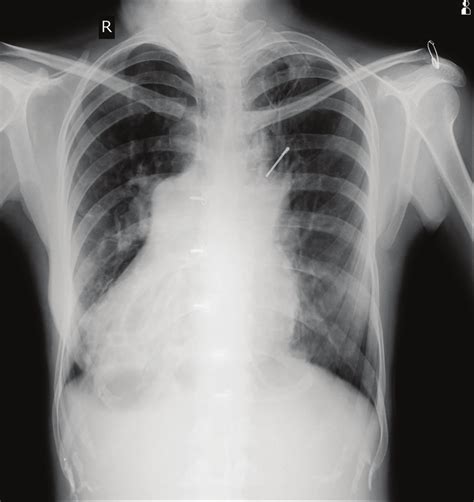 Chest X-ray showing B/L bronchiectasis with dextrocardia. | Download ...