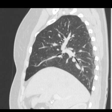 Pulmonary Hydatid Cyst Image Radiopaedia Org