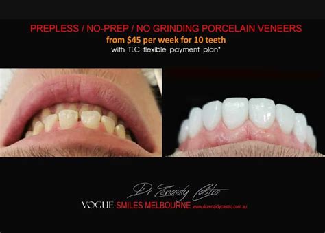 White Spots on Teeth and Enamel Defect Treatment Melbourne