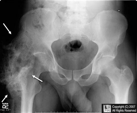 Learningradiology Heterotopic Ossification Ho