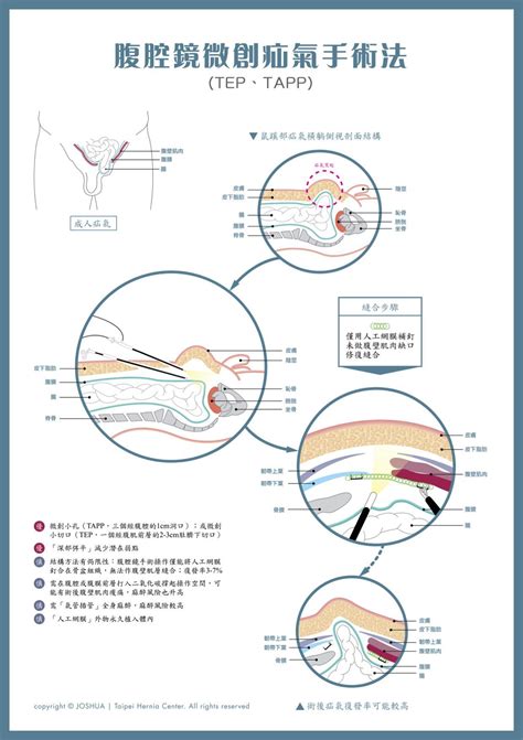 新式微創疝氣手術、腹腔鏡微創疝氣手術、傳統疝氣手術，那種疝氣手術適合我