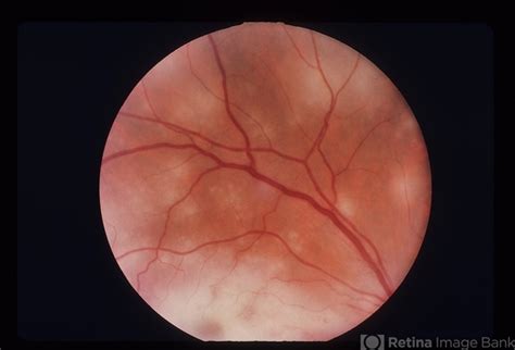 Acute Retinal Necrosis Arn Ophthalmology Education