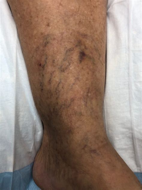 The Types Of Staining That May Occur After Sclerotherapy Vein Therapy