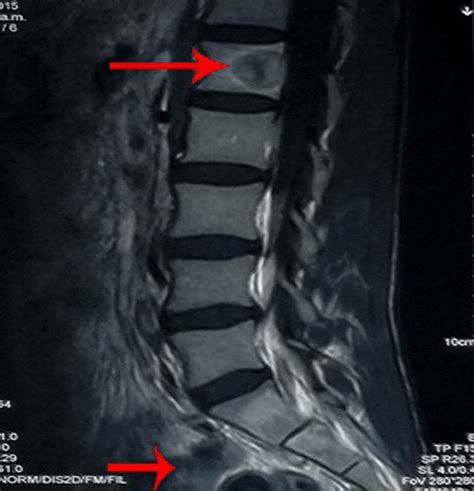 8 Preoperative Magnetic Resonance Imaging Of L1 And S1S2 Reveals Bone