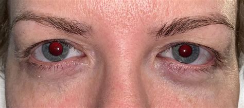 13 Upper Eyelid Surgery Before And After Photos Dallas Plano Texas Cosmetic Reconstructive