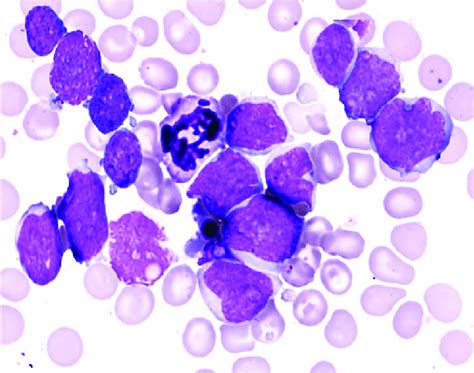 Bone Marrow Aspirate Smear Shows Many Medium To Large Immature Looking