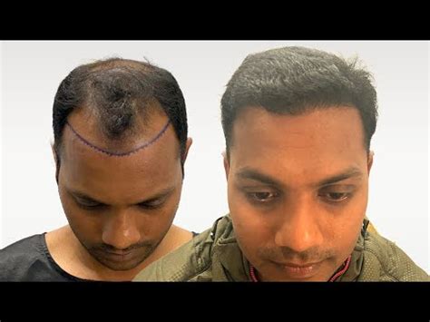 Overcoming Grade 6 Baldness With 4500 Grafts Transplant Stunning 10