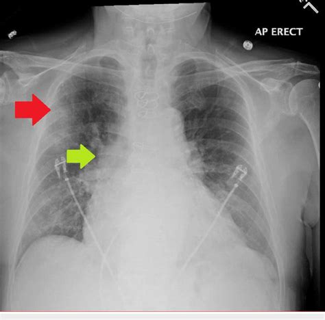 Chest X Ray On Presentation Showing Hazy Right Upper Lobe Opacity Red Download Scientific