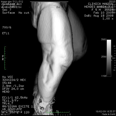 Figure 1 From Popliteal Pterygium Syndrome Semantic Scholar