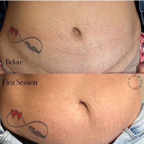 All You Need To Know About Inkless Stretch Mark Removal