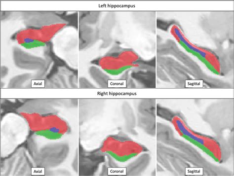 Effects Of White Matter Hyperintensities On Brain Connectivity And