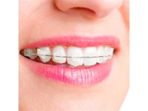 Different Types of Dental Braces | Roseville, CA Patch