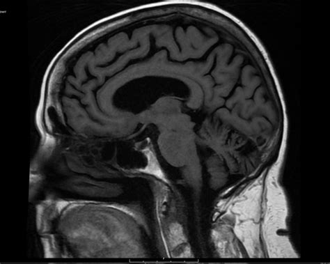 MRI Brain without Contrast - Greater Waterbury Imaging Center