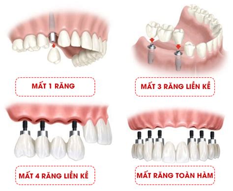 C Y Gh P R Ng Implant Th M M Nha Khoa Ng