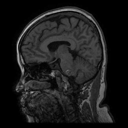 Cavernoma With Developmental Venous Anomaly Image Radiopaedia Org