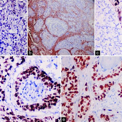 Immunohistochemical Analysis A Positive Pcna Immunoexpression In Download Scientific Diagram