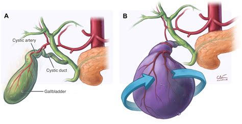 Gallbladder Torsion Radiographics