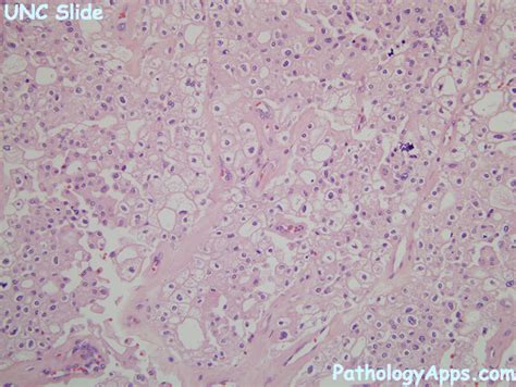 chromophobe rcc pathology