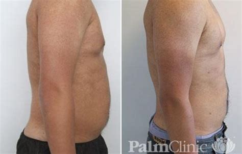 Male Abdomen Liposuction Before And After Photos Palm Clinic