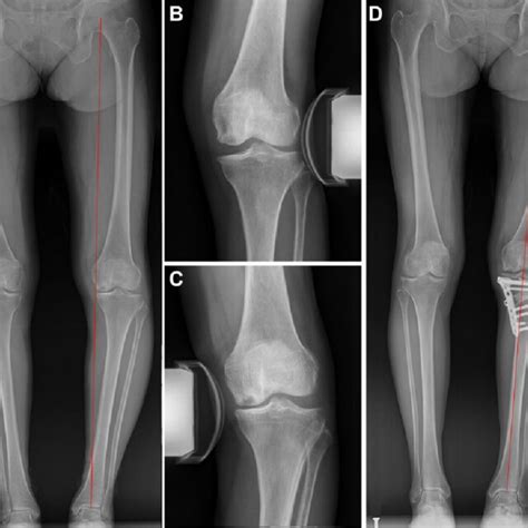 A Year Old Female Patient Who Underwent Opening Wedge High Tibial