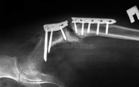 Broken bone xray stock image. Image of medical, chest - 17556731