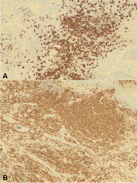 (A) (200×) Immunohistochemical stains show strong positivity of the ...