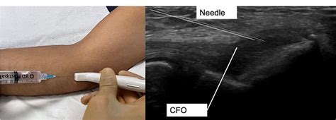 Effective Golfer S Elbow Injection MSK Ultrasound Injections