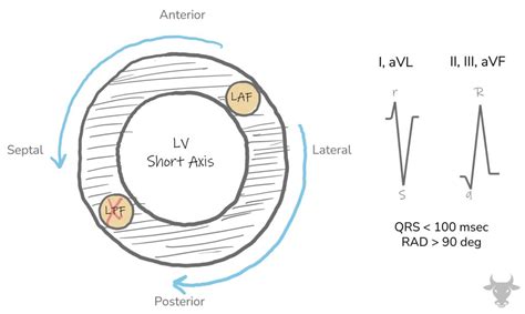 Left Posterior Fascicular Block | ECG Stampede