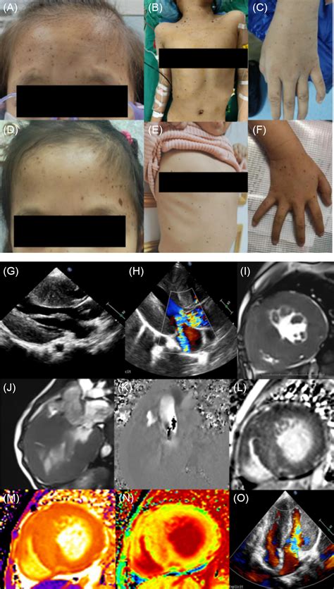 Leopard Syndrome With Ptpn Gene Mutation In Monozygotic Twins A Case