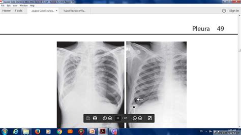 Pneumothorax Pptx D Majeed Muhadharaty