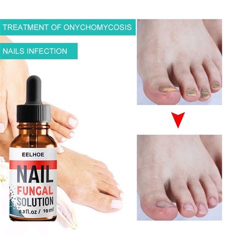 Eelhoe Nail Fungal Treatment Rawat Kulat Kuku Hapus Kulat Kuku Nail