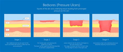 What Are Bed Sores – NBKomputer