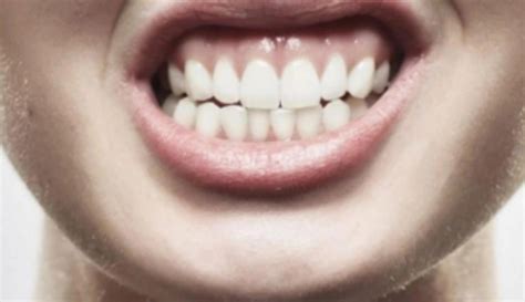 5 Practical Tips On How To Stop Teeth Grinding