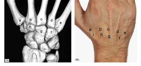 Figure From (i) Examination Of The Wrist—surface Anatomy, 44% OFF