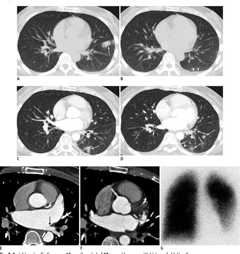 Figure 2 From Lung Infarction Due To Pulmonary Vein Stenosis After Ablation Therapy For Atrial