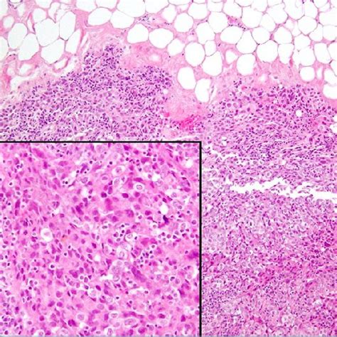 Medullary Carcinoma Of The Breast The Large Atypical Epithelioid Cells