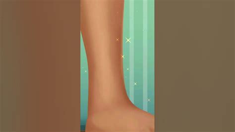 Ankle Fracture Surgery Animation Broken Foot Youtubeshorts Shorts